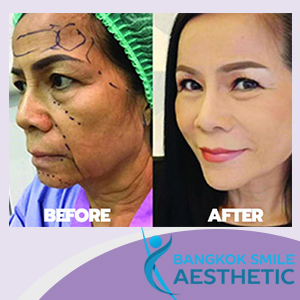 Bangkok Smile Aesthetic Clinic